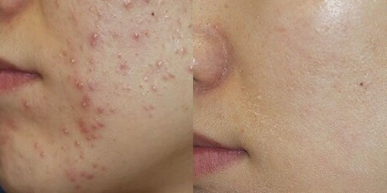 激光去痘印 副作用有哪些?避开误区,科学护肤更安全!- The Beauty 101